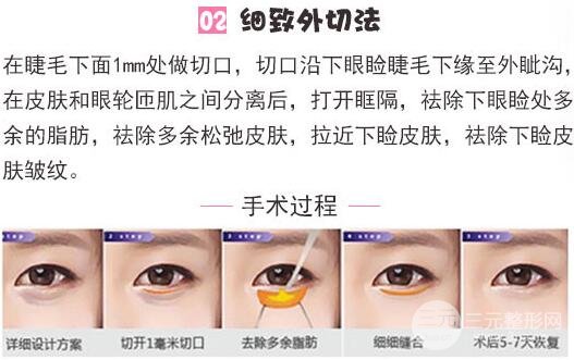 外切去眼袋手术原理
