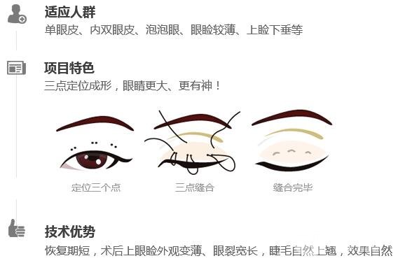 微创定点式好吗 双眼皮手术原理介绍