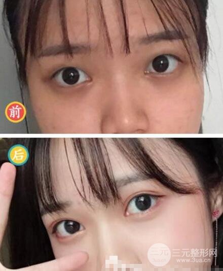 微创定点式好吗 术后果图