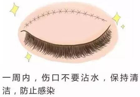 微创定点式双眼皮好不好 术后护理