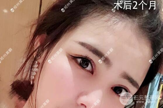 开眼角手术多久恢复 过程图片分享