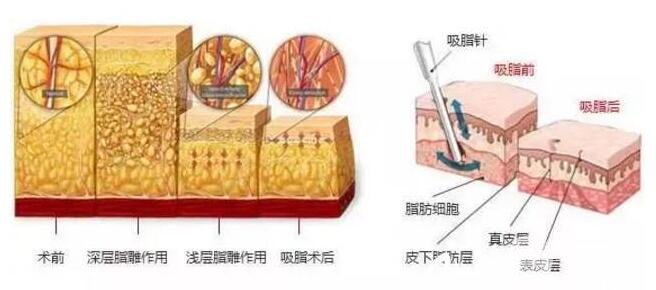 什么是吸脂瘦臀手术?吸脂瘦臀原理