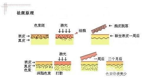 哪些方式可以去黄褐斑呢?