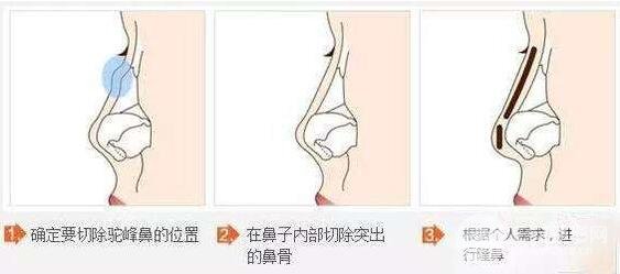 驼峰鼻矫正有什么方式?