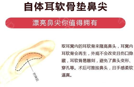 上海自体耳软骨隆鼻价格多少钱？