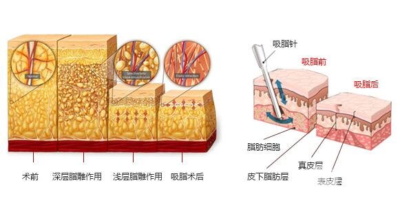 脂减肥的原理是什么?
