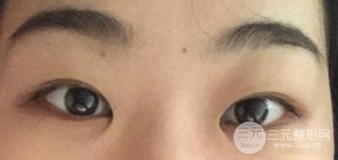 什么是开眼角手术?