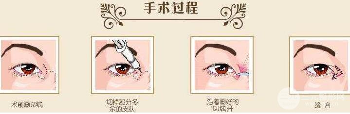 什么是开眼角手术?