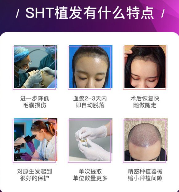 上海碧莲盛植发正规吗?