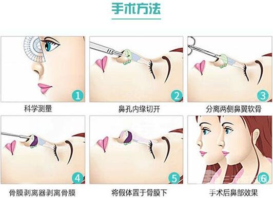 曼特波隆鼻降低风险吗 手术原理