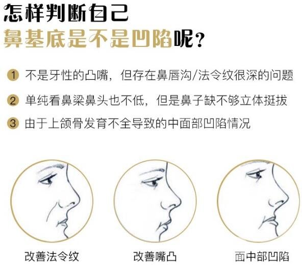 假体垫鼻基底多少钱？贵不贵