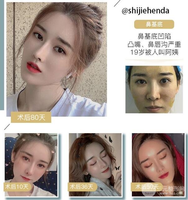 假体垫鼻基底多少钱 果好不好