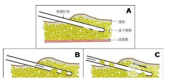 啥是大腿吸脂手术?手术原理