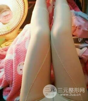 大腿吸脂手术案例