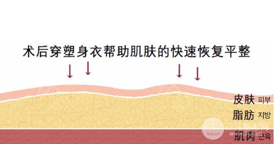 大腿吸脂手术可以维持多久?