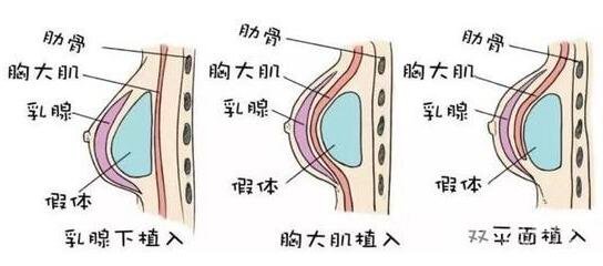 乳房假体植入手术的过程及原理剖析