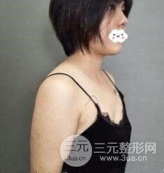 乳房假体植入手术术前