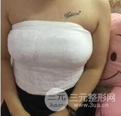 乳房假体植入手术术后一周