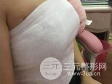 乳房假体植入手术术后一周