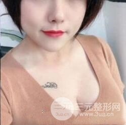 乳房假体植入手术术后半年