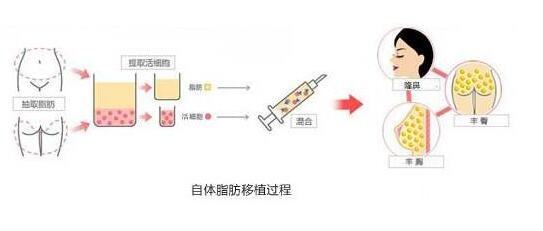 自体脂肪隆鼻的原理