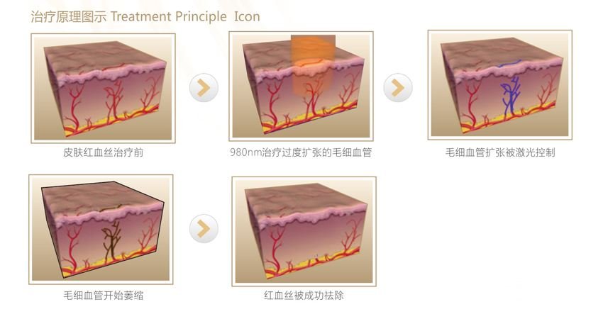 激光去红血丝靠谱吗 价格是多少？