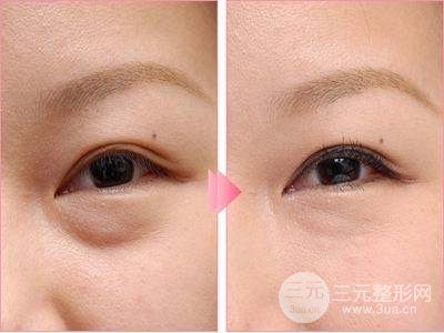 激光去眼袋多少钱 会反弹吗