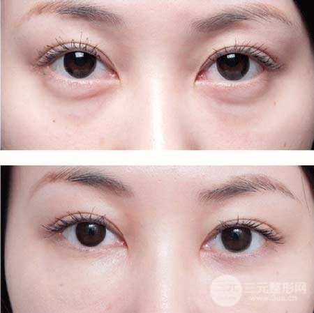 激光去眼袋多少钱 会反弹吗