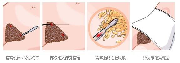 腰部吸脂减肥手术原理