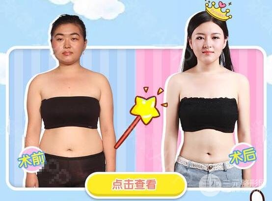 腰部吸脂减肥价格多少钱 果好不好