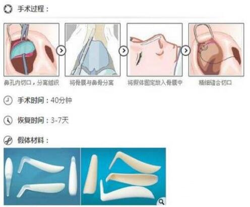 硅胶隆鼻手术的原理是啥?
