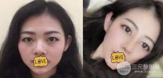 硅胶隆鼻手术案例