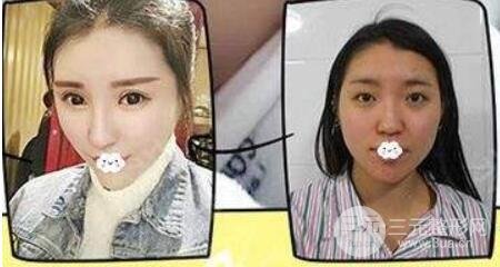 硅胶隆鼻手术案例