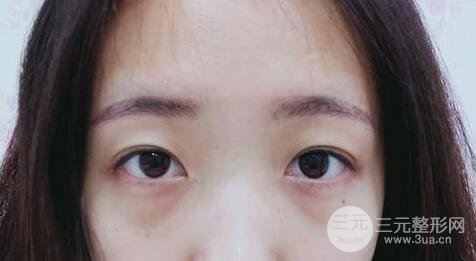外切去眼袋手术果,会留疤吗?