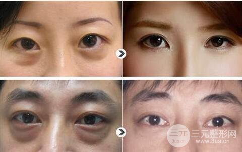 外切去眼袋手术案例