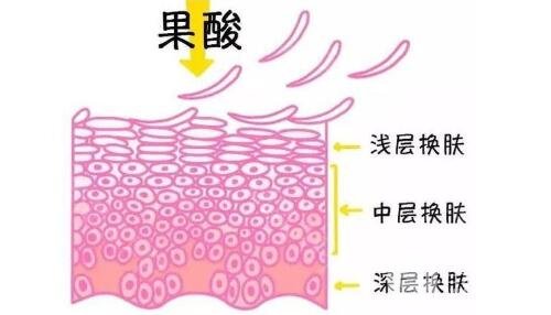 什么是果酸换肤?