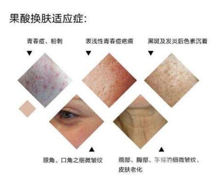 什么是果酸换肤?