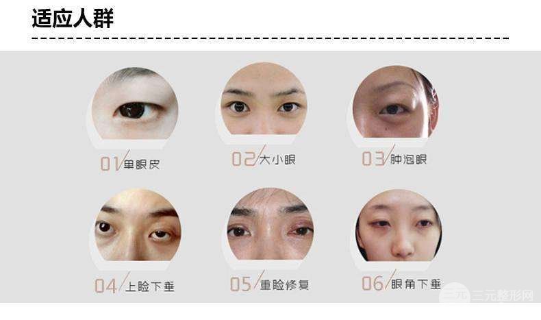 做定点双眼皮过程是怎样的？适合人群有哪些？