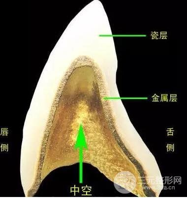 北京大学口腔医院烤瓷牙 北京大学口腔医院烤瓷牙