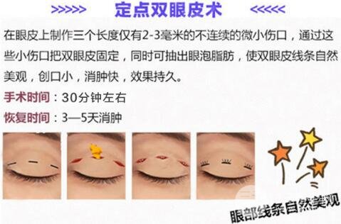 做定点双眼皮手术过程