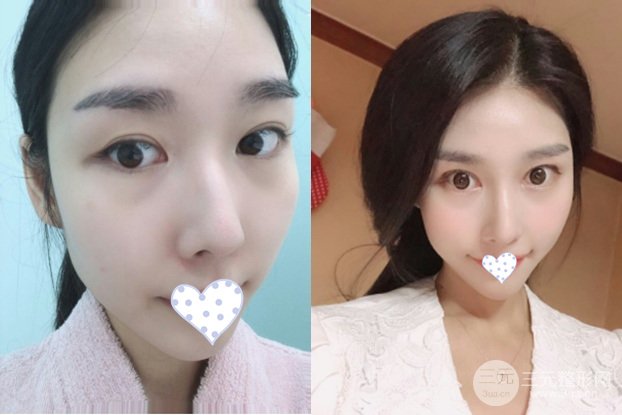 做定点双眼皮果怎么样 需要拆线吗