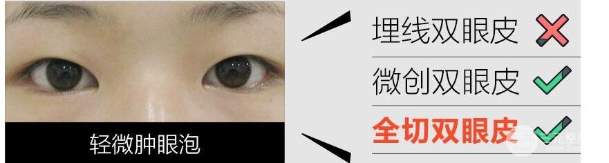 做定点双眼皮手术适合哪些人