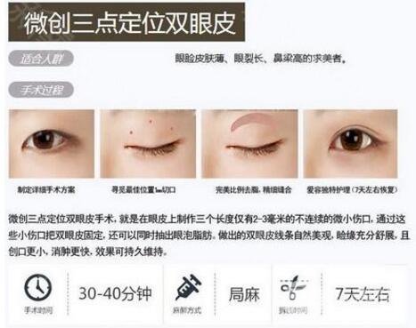 韩式定点双眼皮手术简介
