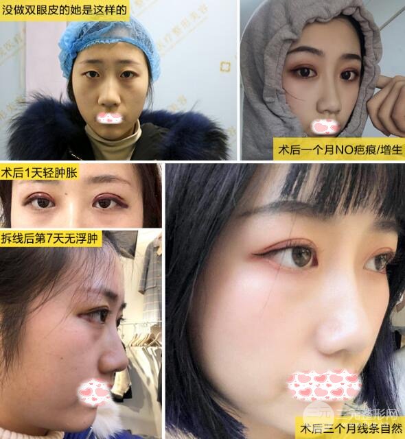 定点双眼皮手术果好不好