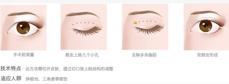 定点双眼皮手术是什么