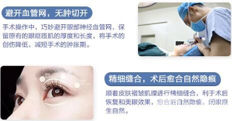 定点双眼皮是长时间吗