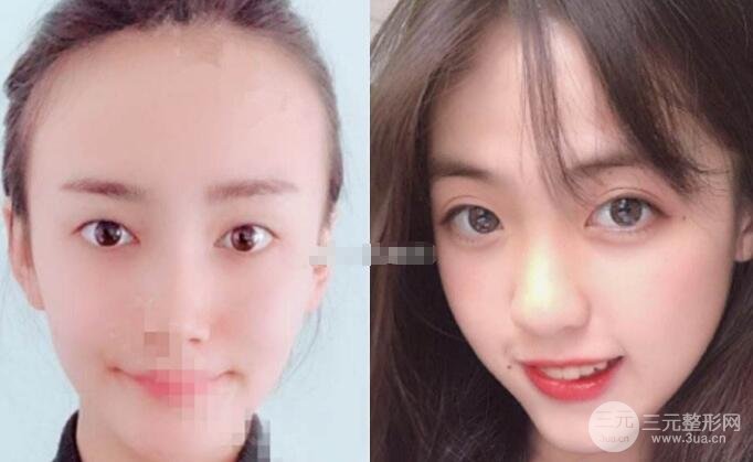 定点双眼皮适合哪些人