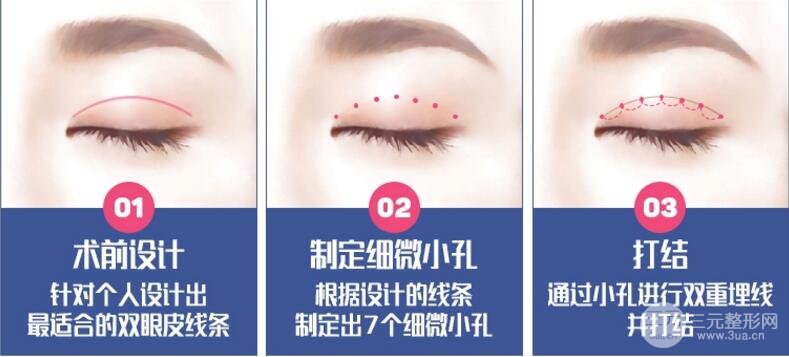 韩式定点双眼皮手术能维持几年