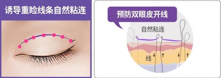 韩式定点双眼皮有什么优点