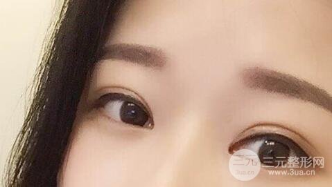 全割双眼皮后的注意事项